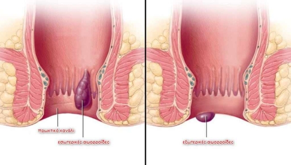 Αιμορροϊδοπάθεια και θεραπεία
